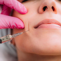 a person receiving a dermal filler injection in the cheek to treat Nasolabial Folds